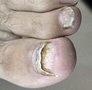 Nagelpilz gestartet