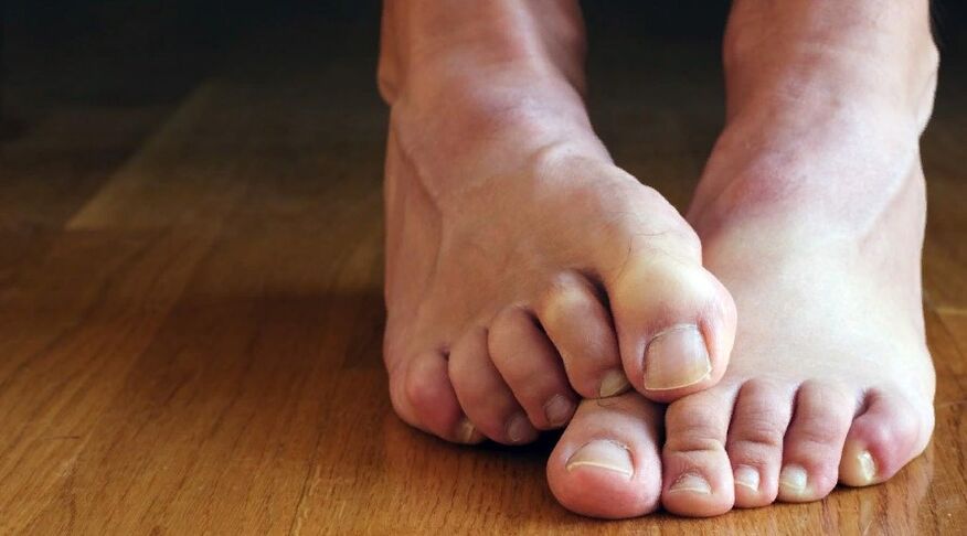 Symptome von Nagelpilz