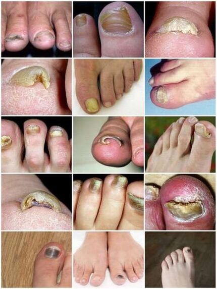 Pilzinfektion der Zehennagelplatte