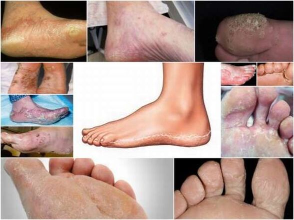 Plattenepithelkarzinom-hyperkeratotische Form der Mykose der Füße