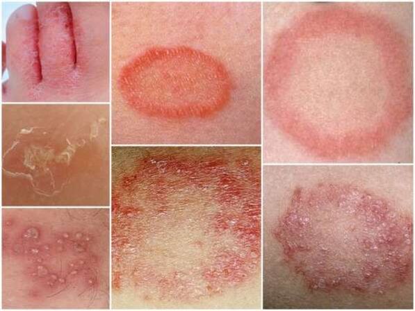 Trichophytose der Haut der Beine