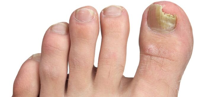 Pilzinfektion der Nagelplatte